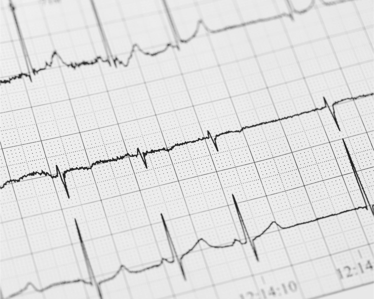 Ηλεκτροκαρδιογράφημα