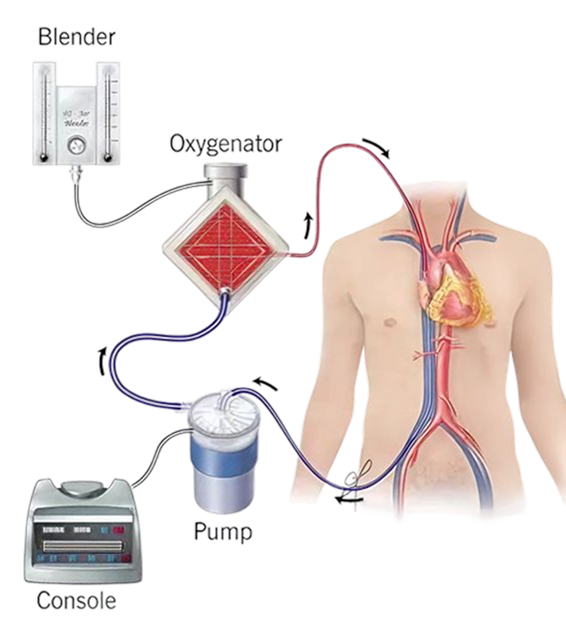 ECMO Diagram