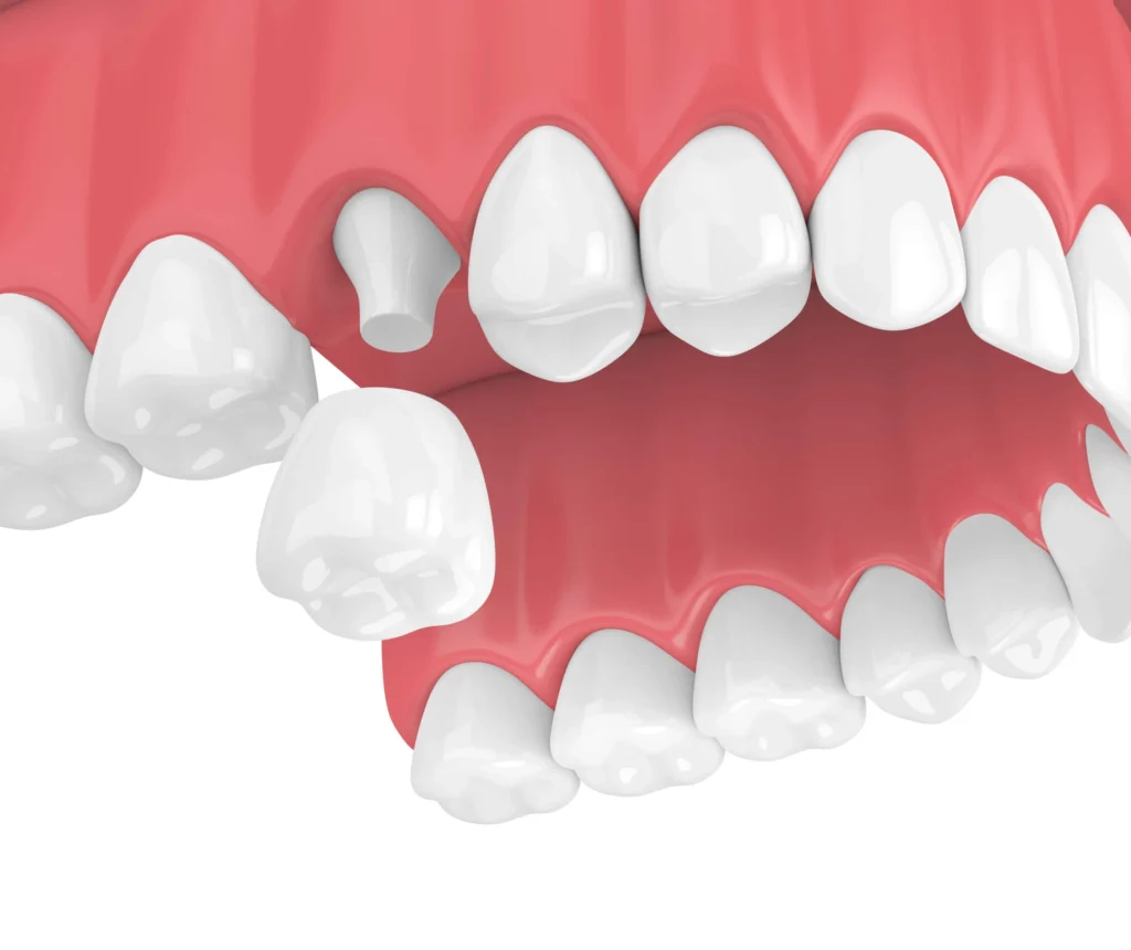 3D image of dental crowns Davie FL