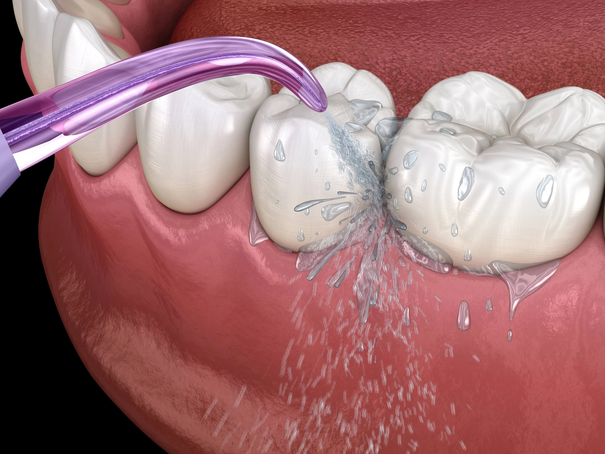 3D Illustration of Davie teeth cleaning