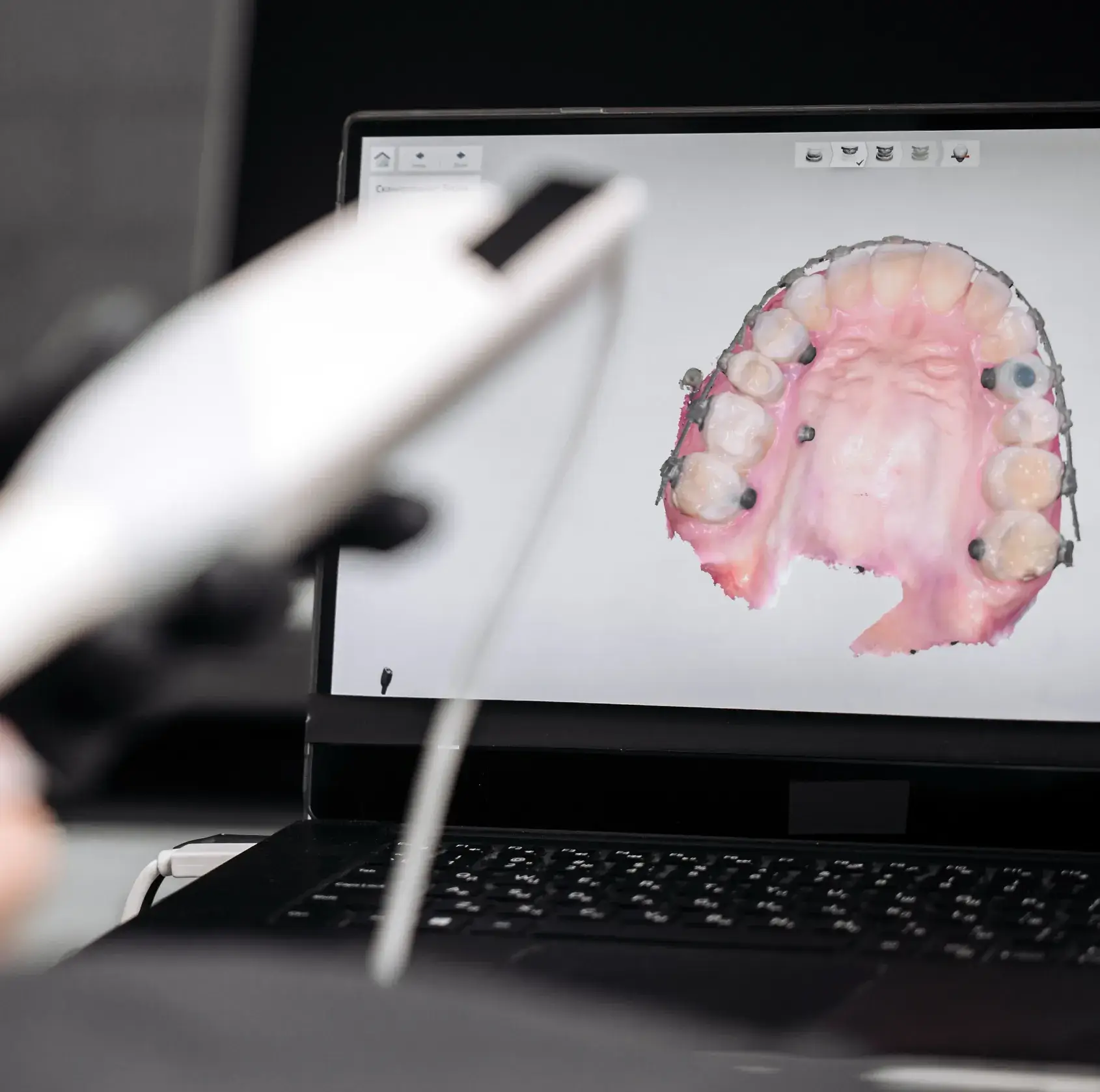 Dental scanner held in front of a laptop displaying a 3D model of the upper teeth and gums.
