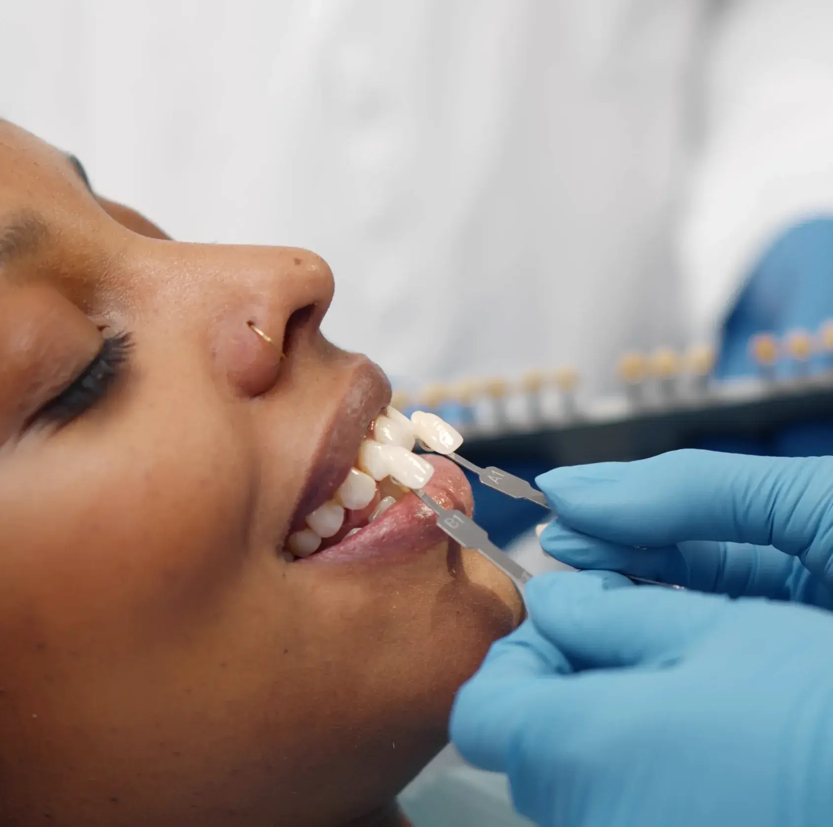 Close-up of a smiling person during a dental shade matching procedure for teeth whitening.