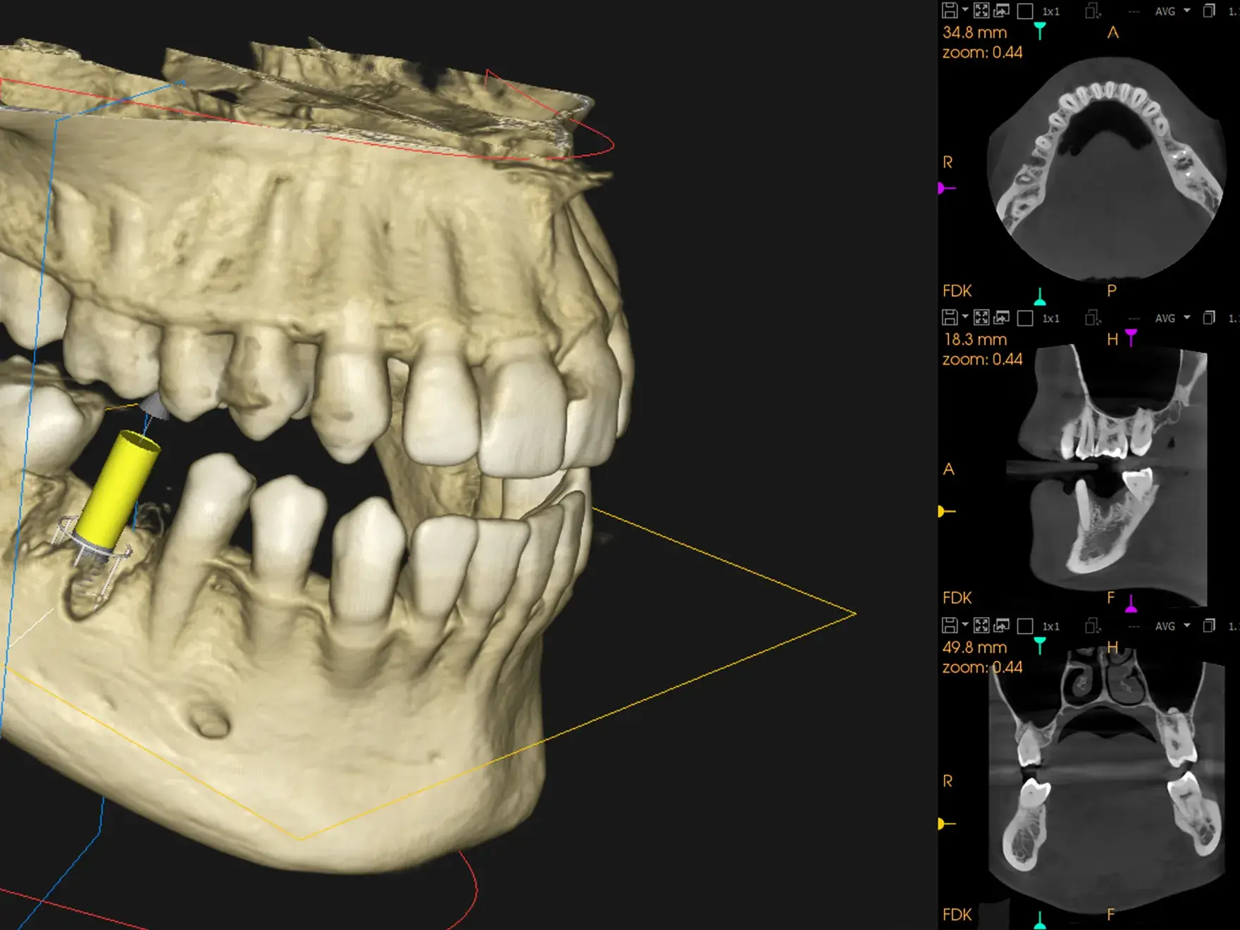 3D dental scan showing upper and lower jaw with a yellow cylinder indicating a planned dental implant, alongside multiple cross-sectional X-ray views of the teeth and jaw.