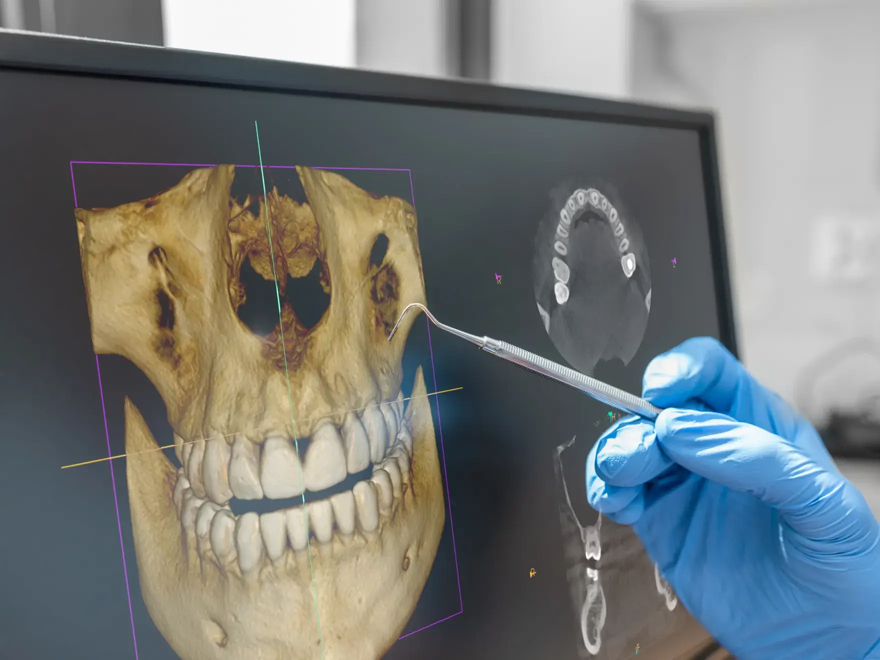Gloved hand holding a dental tool pointing at a 3D dental X-ray image on a computer screen.