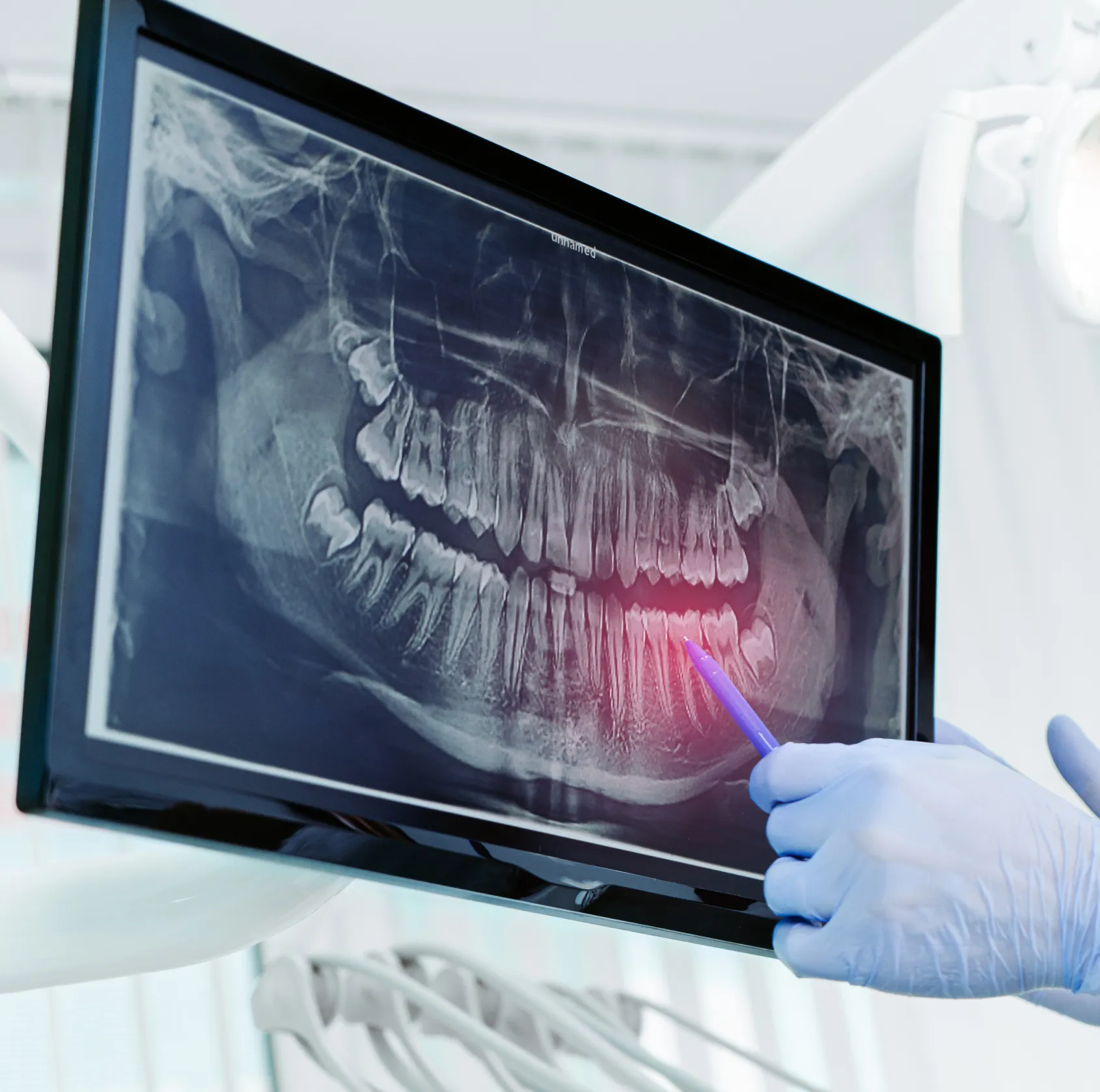 Dental X-ray on screen showing full set of teeth with a gloved hand pointing to a specific lower tooth with a pen.