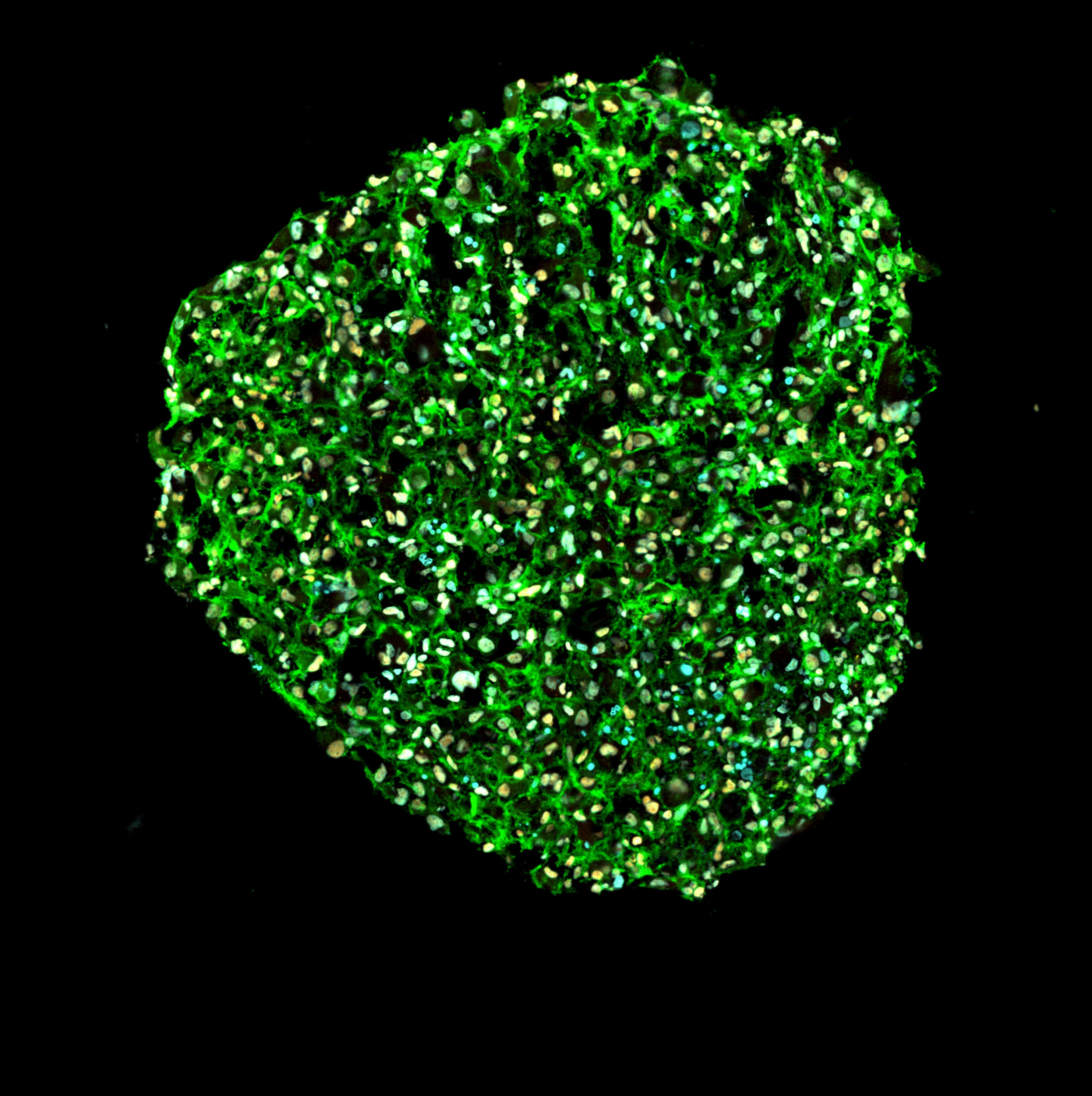 Glioblastoma organoid, immunofluorescence, EGFR and SOX2
