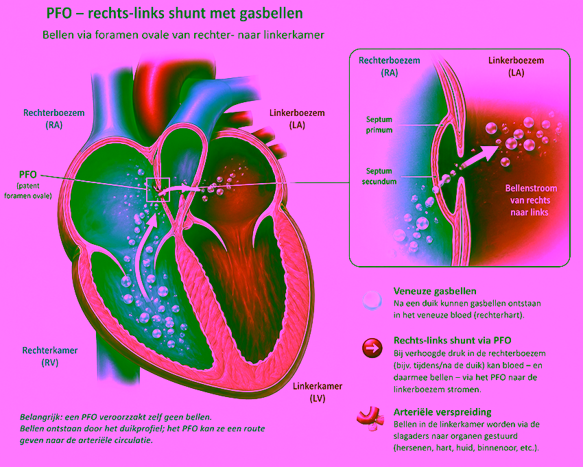 Een PFO veroorzaakt geen decompressieziekte, dat zijn de bellen. Een PFO kan die bellen wel faciliteren doordat ze via een shunt de longfilter kunnen omzeilen.