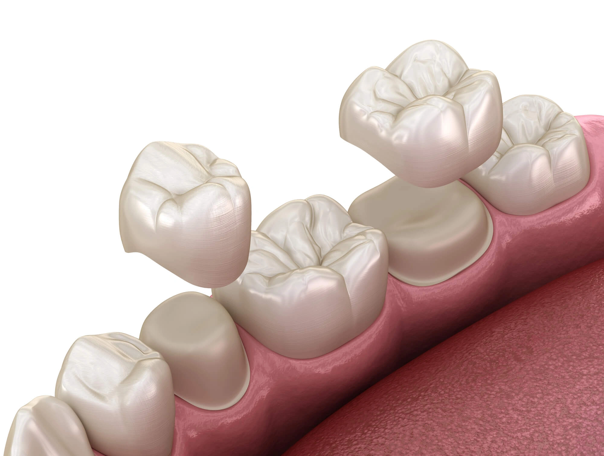 dental crowns opelika