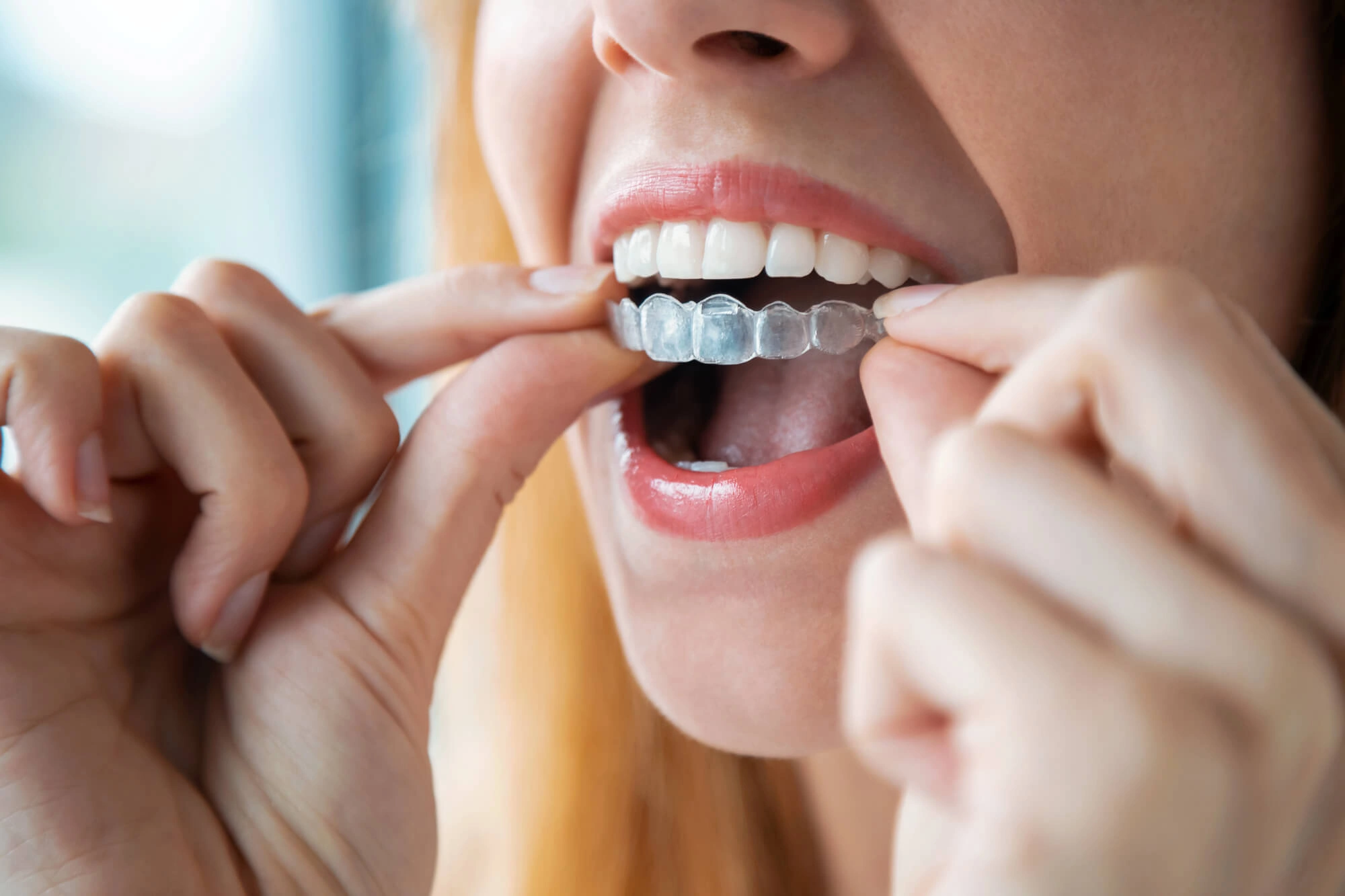 Invisalign aligners by orthodontics opelika al