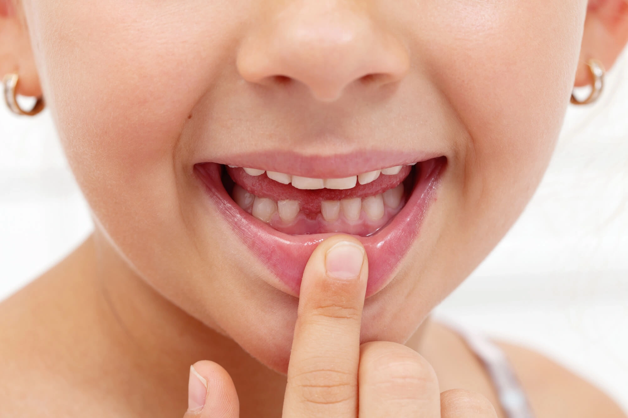 Tooth extracted by pediatric dentist in opelika al