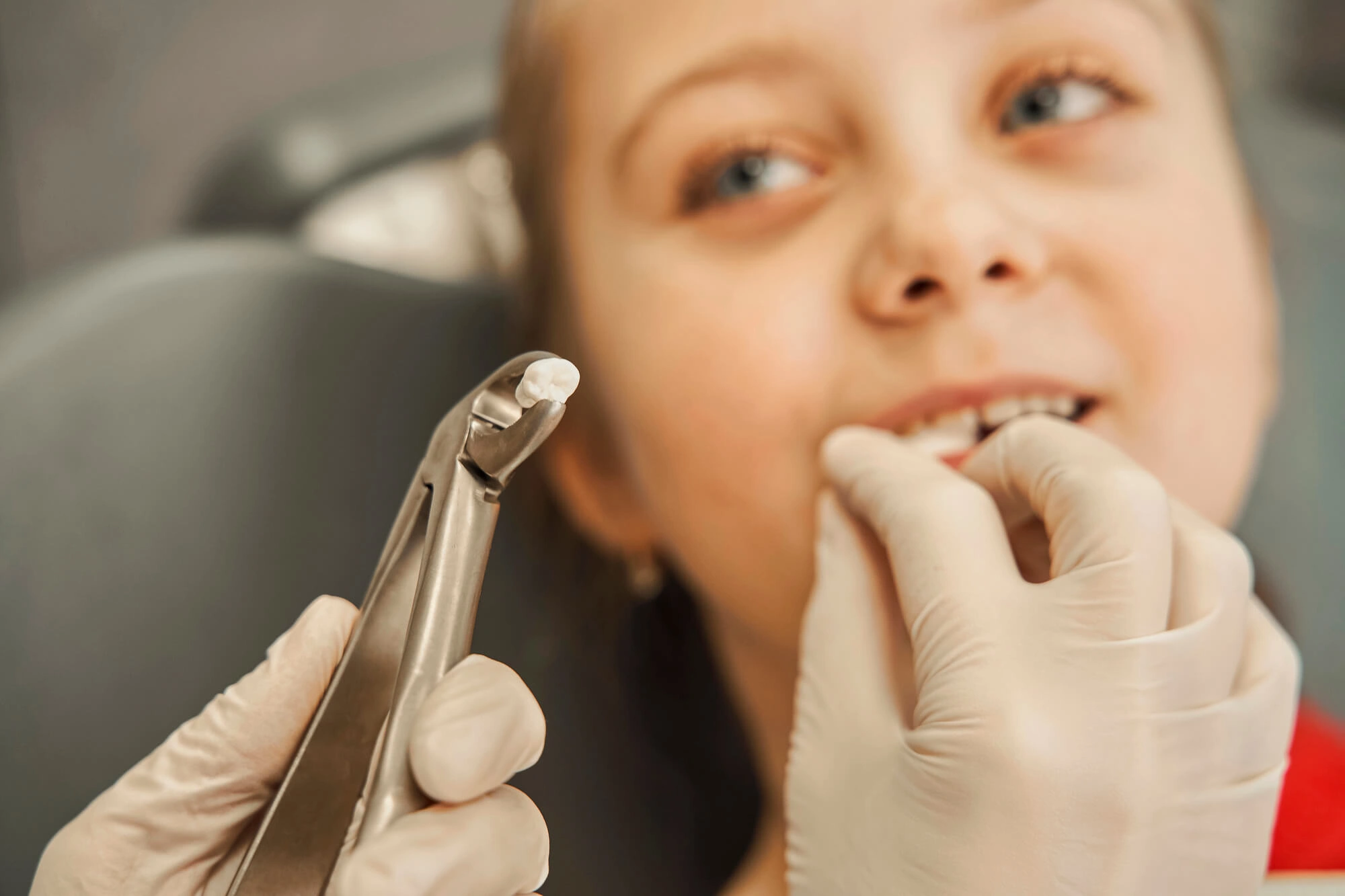 Tooth Extraction by pediatric dentist in opelika al