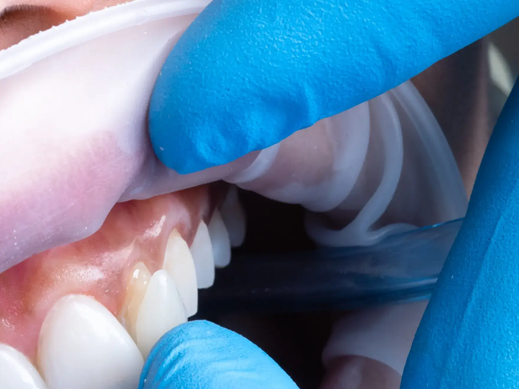 Close-up of a dental professional wearing blue gloves placing a clear dental tray over a patient's upper teeth.