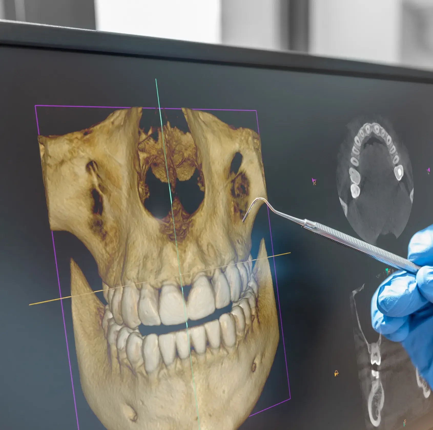 Dental 3D scan on a computer screen showing a skull with teeth and a gloved hand holding a dental tool pointing at the scan.