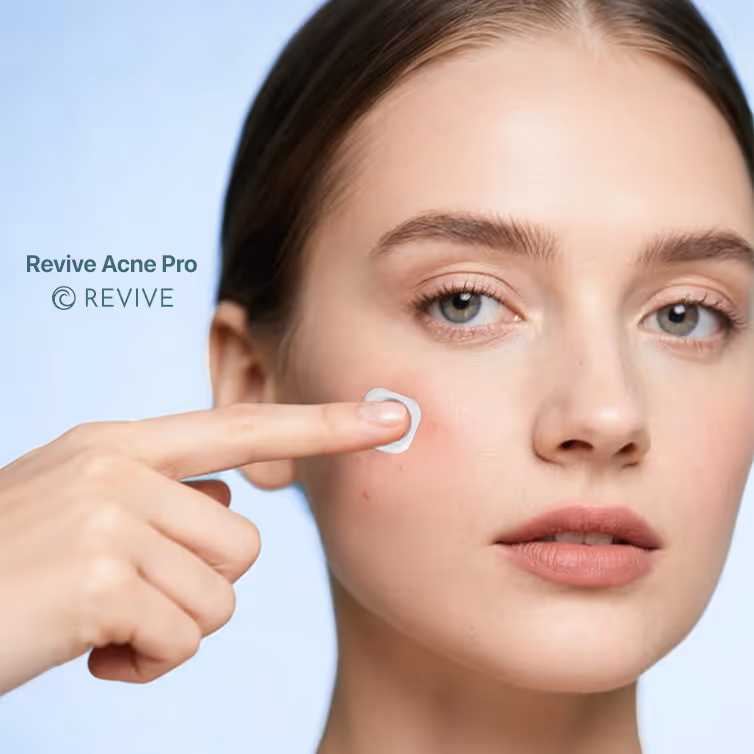Close-up of a woman applying skincare cream to a pimple on her cheek, with Revive Acne Pro branding visible.