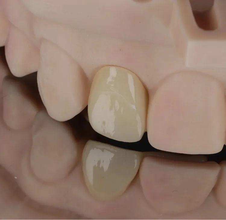 Close-up of dental model focusing on a single polished artificial tooth among natural teeth.