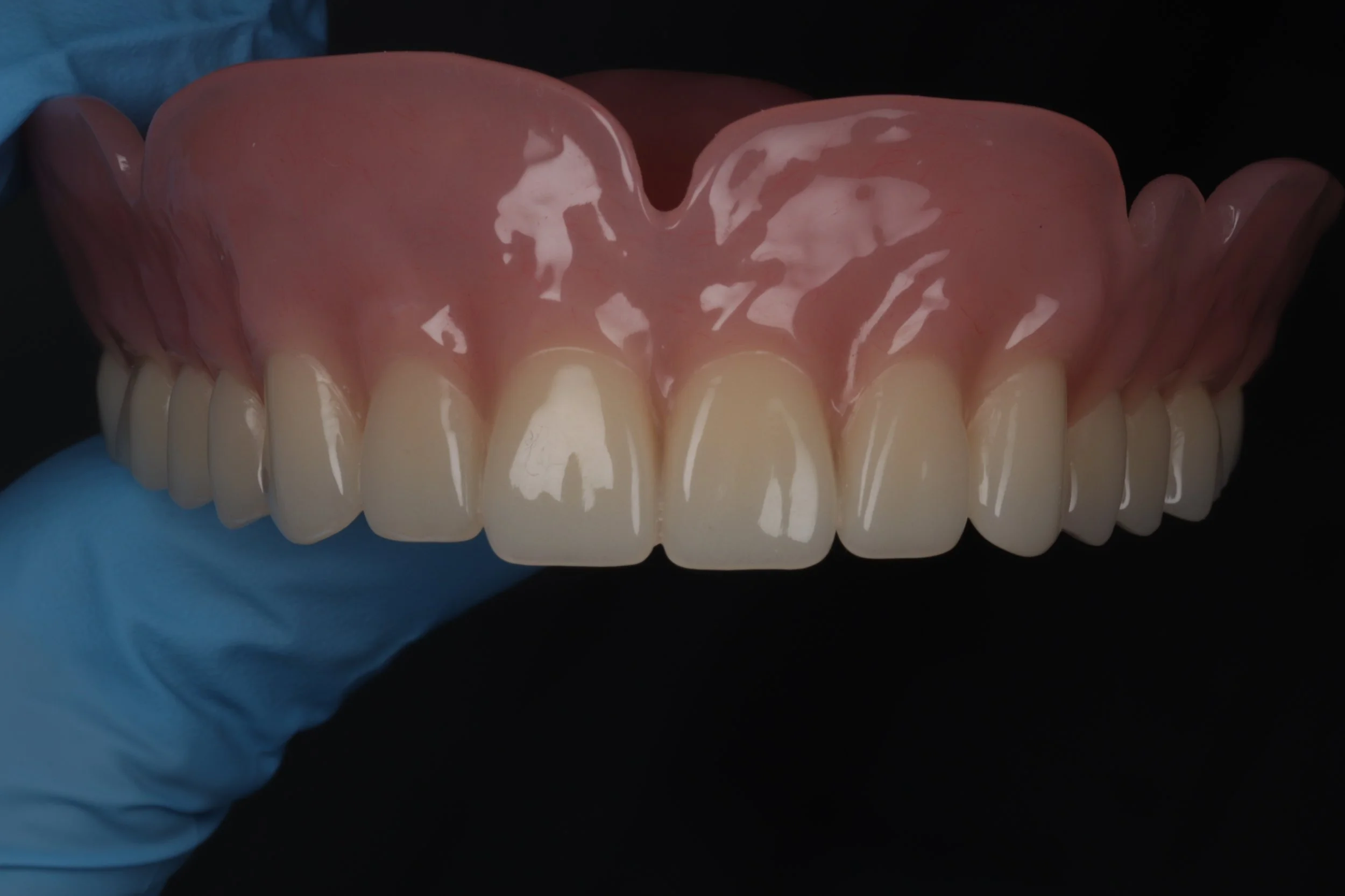 Close-up of a full upper denture held by a hand wearing a blue glove against a black background.