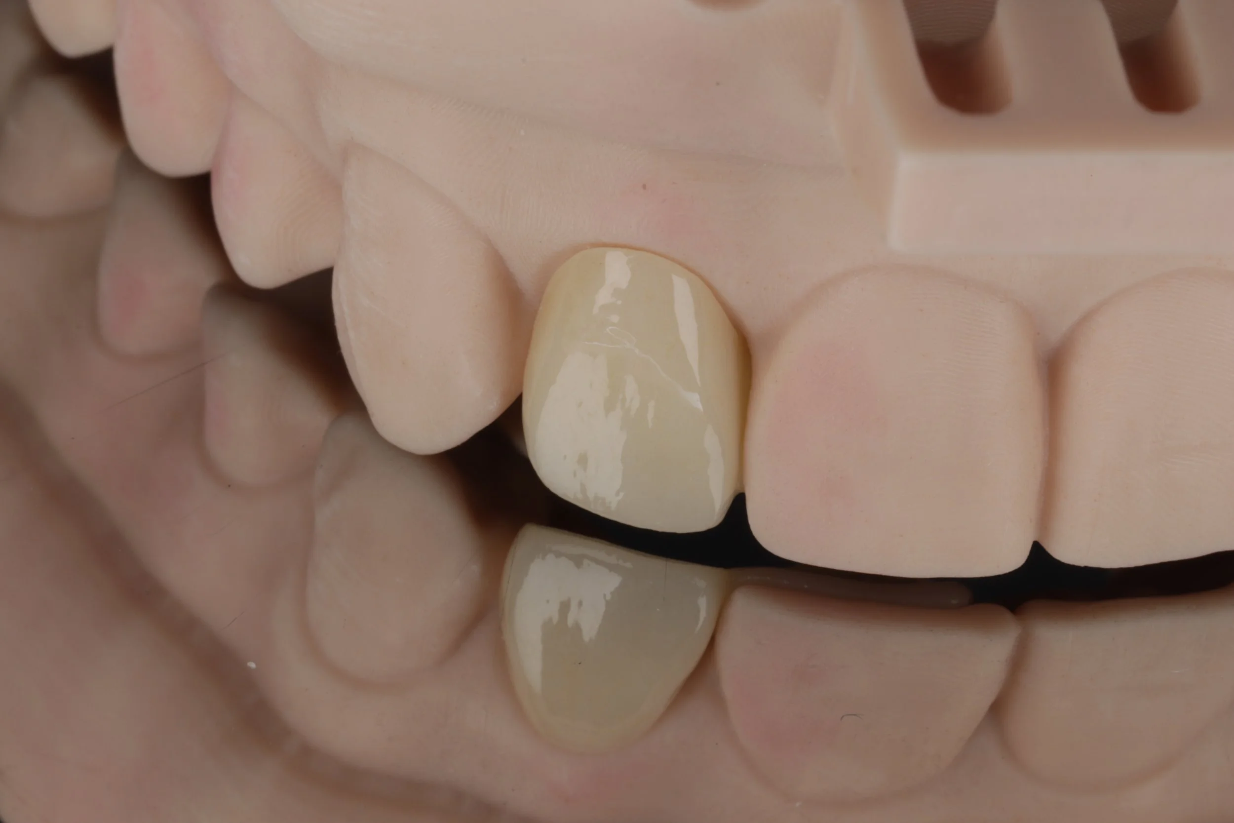 Close-up of a dental model showing a single ceramic tooth crown among natural-colored teeth.