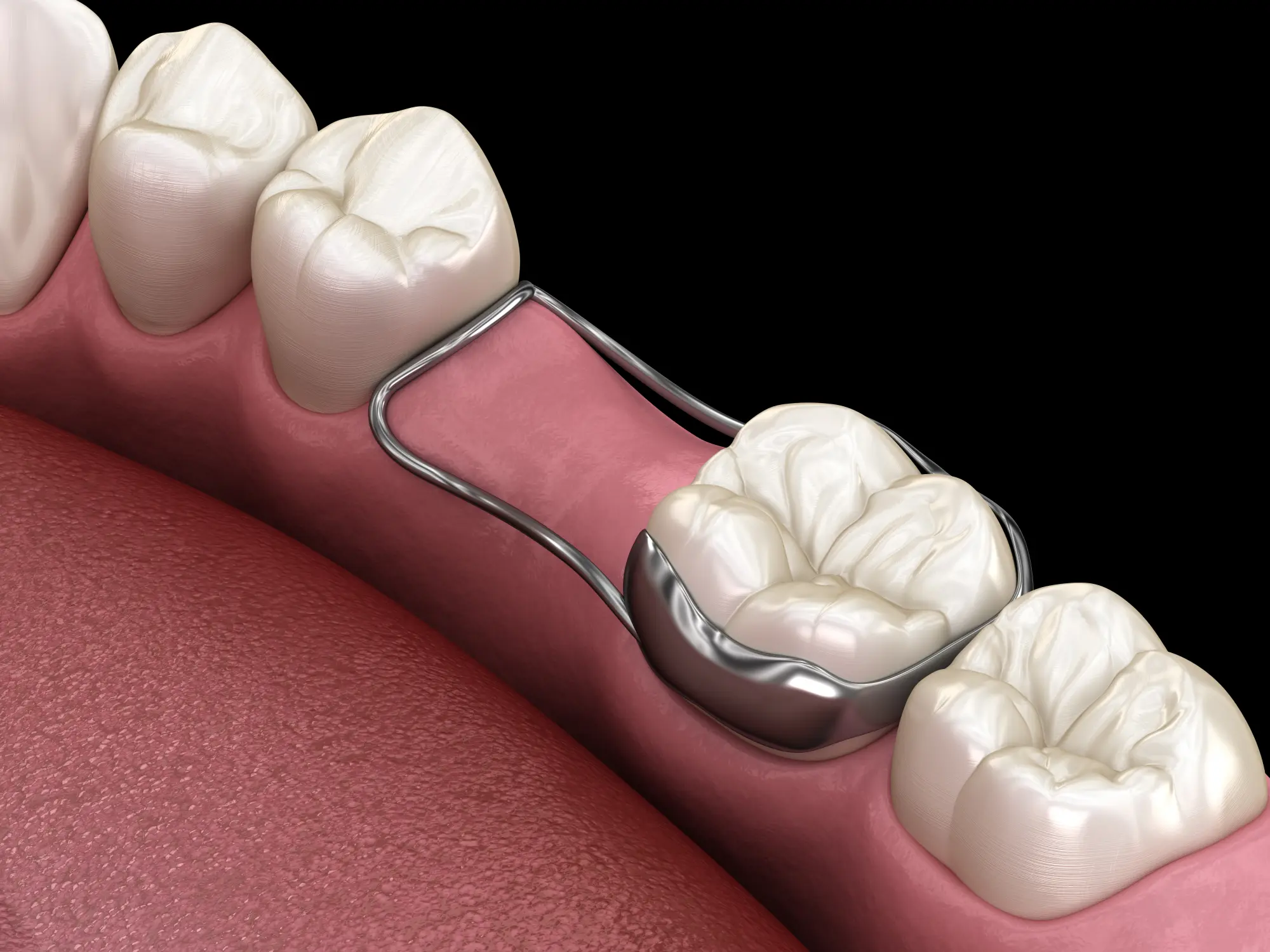 Space Maintainers in Frederick and Thurmont, MD | Adrienne Saltos Kramer Orthodontics
