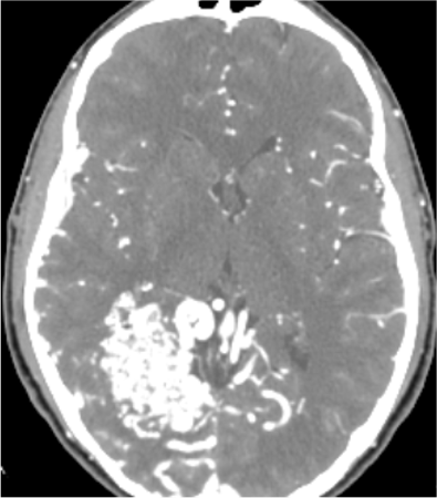 Axial CT angiogram of the brain showing cerebral blood vessels with a cluster of abnormal tangled vessels in the left posterior region.