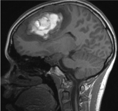 Sagittal MRI scan of a human brain showing a bright, irregular mass in the upper left region.