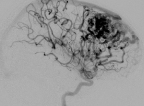 Black and white cerebral angiogram showing blood vessels in the brain with a concentration of vessels in the upper right region.