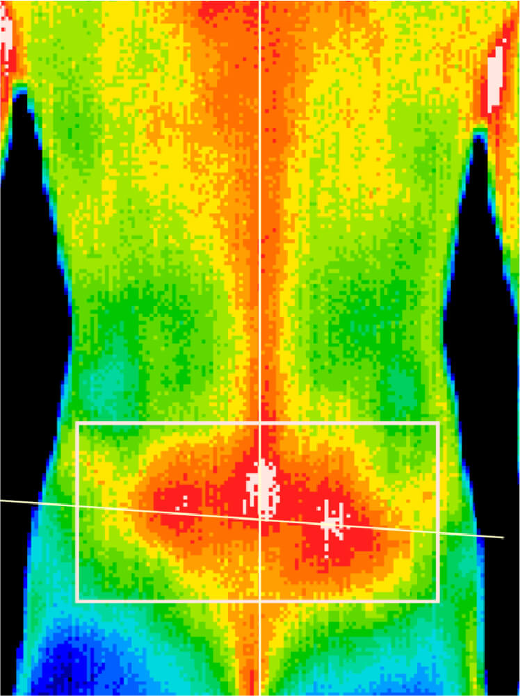 Heat map of a human back showing temperature variations with red and orange on the lower back indicating higher heat areas.