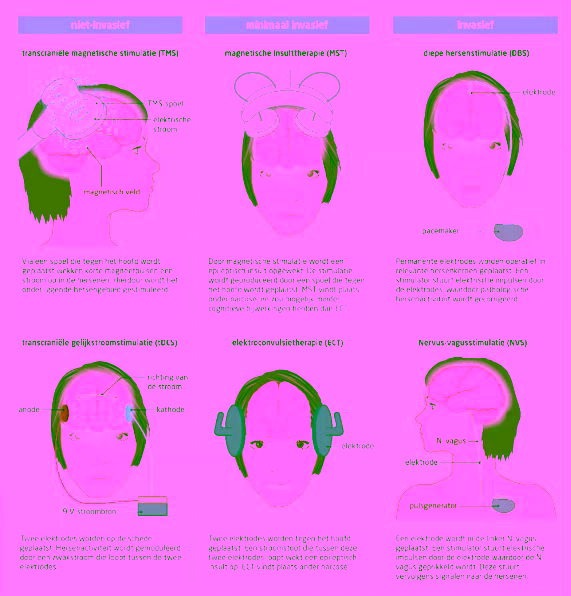 infographic on this topic — non-invasive, minimally invasive, and invasive brain stimulation therapies