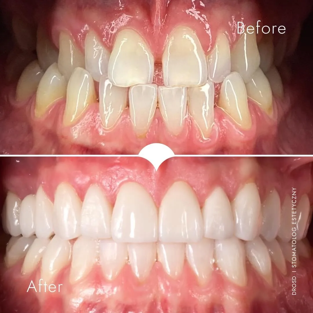 dr-maciej-drosd-licowki-metamorfoza