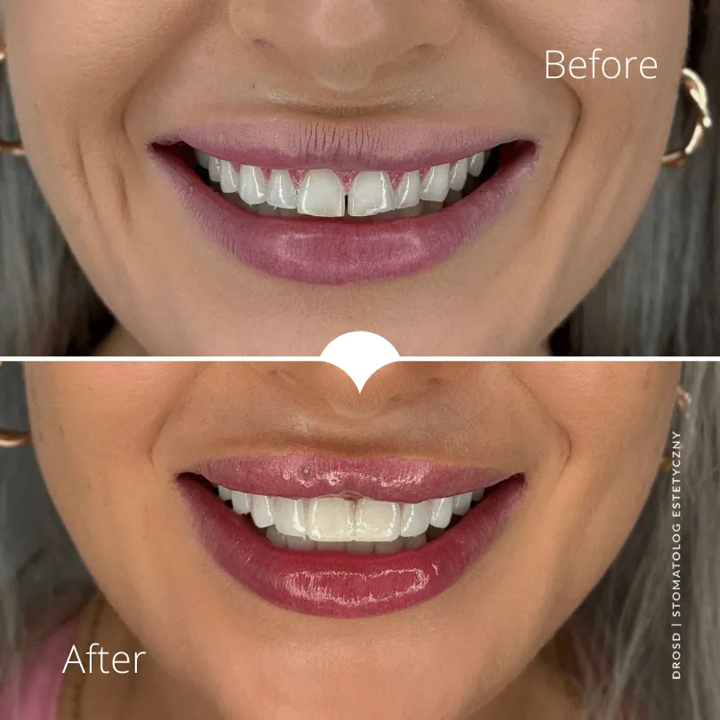 magda-kedra-metamorfoza-licowki-dr-drosd