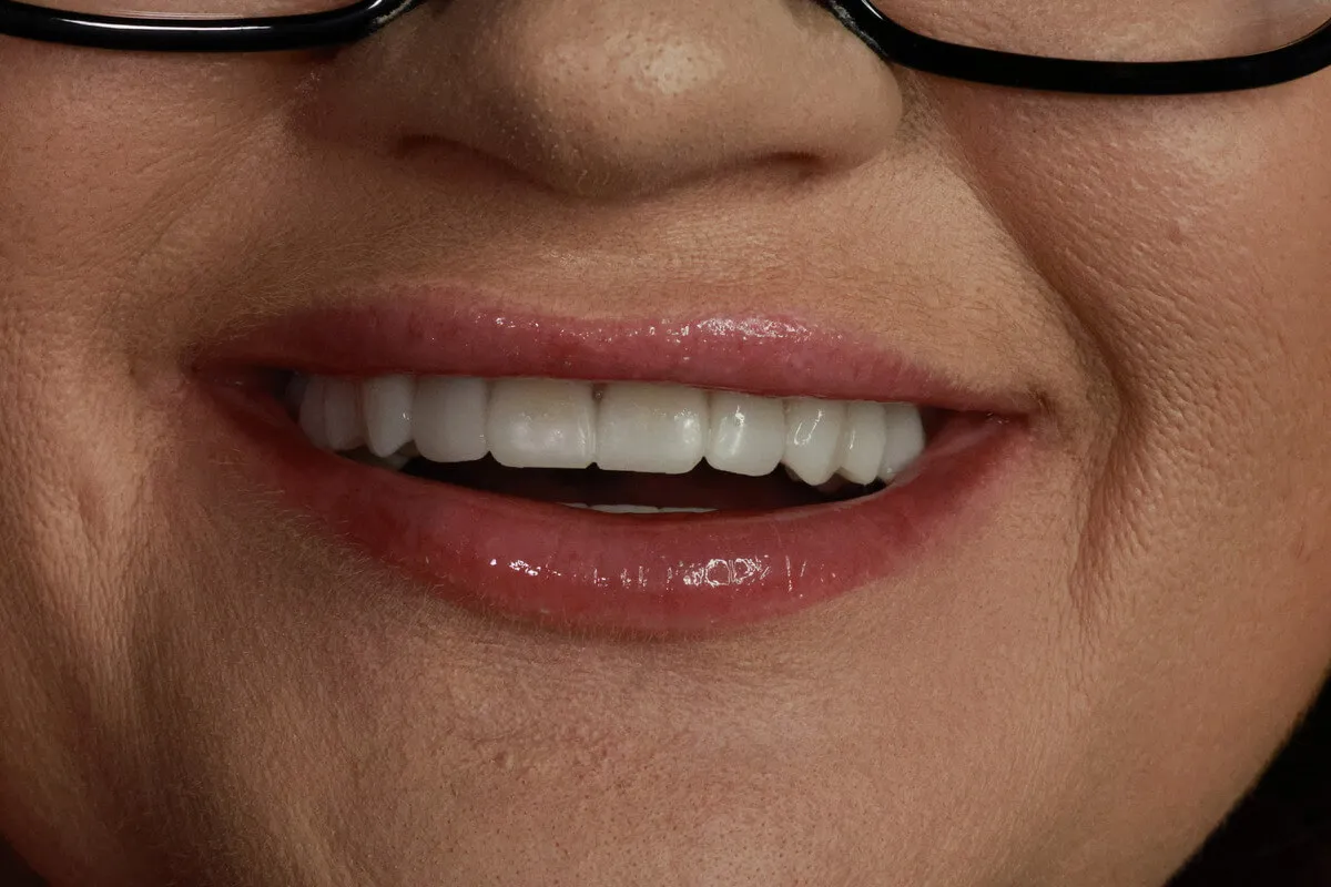 Backward planning w implantologii - planowanie od efektu końcowego w Dental Camp Toruń