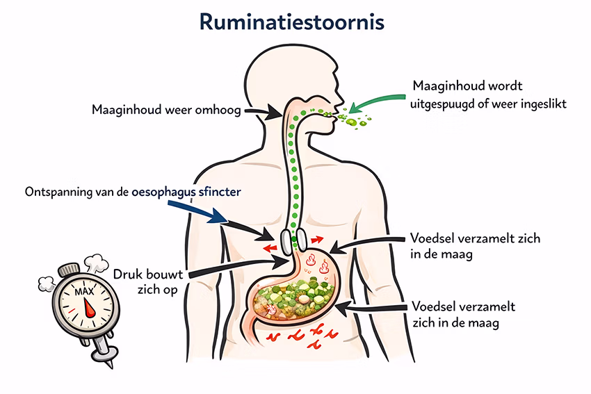 Schematische weergave van ruminatiestoornis, waarbij maaginhoud weer omhoogkomt en opnieuw wordt uitgespuugd of ingeslikt