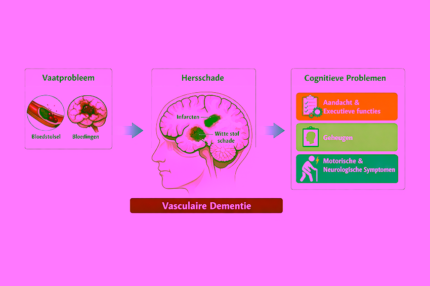 Schema van vasculaire dementie waarbij vaatproblemen leiden tot hersenschade en vervolgens tot cognitieve en neurologische symptomen.