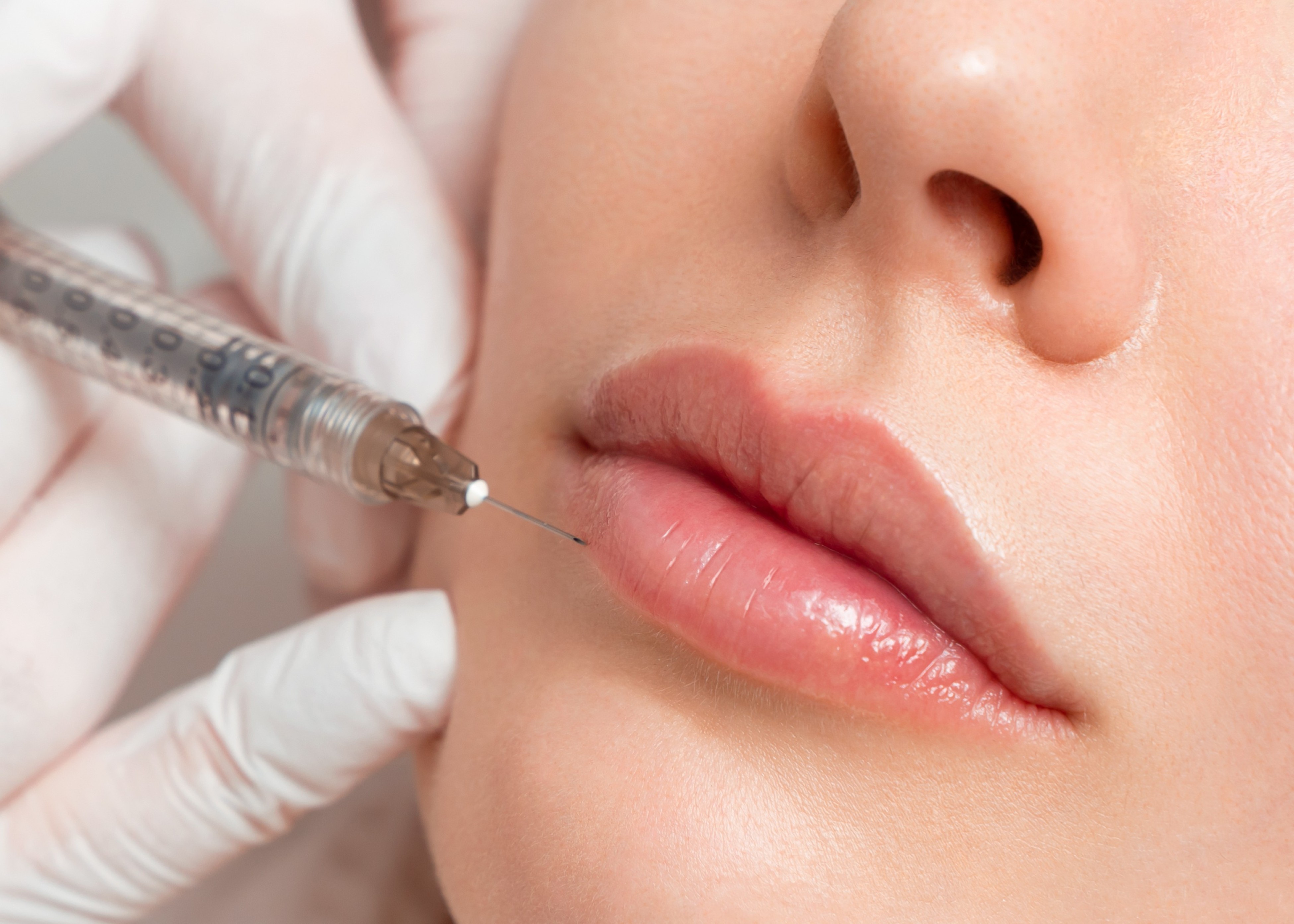 Lip filler treatment at SomaSou MedSpa in Alexandria, VA