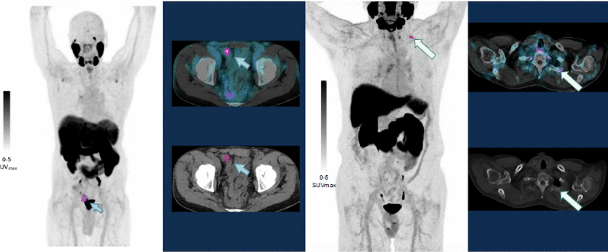 Figure from the EJNMMI Research publication showing 18F-DCFPyL PET/CT images detecting recurrent prostate cancer
