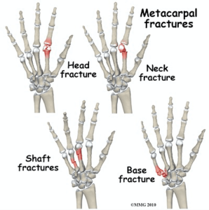 Fifth metacarpal boxer’s fracture diagram showing why boxing hand wraps protect the knuckles