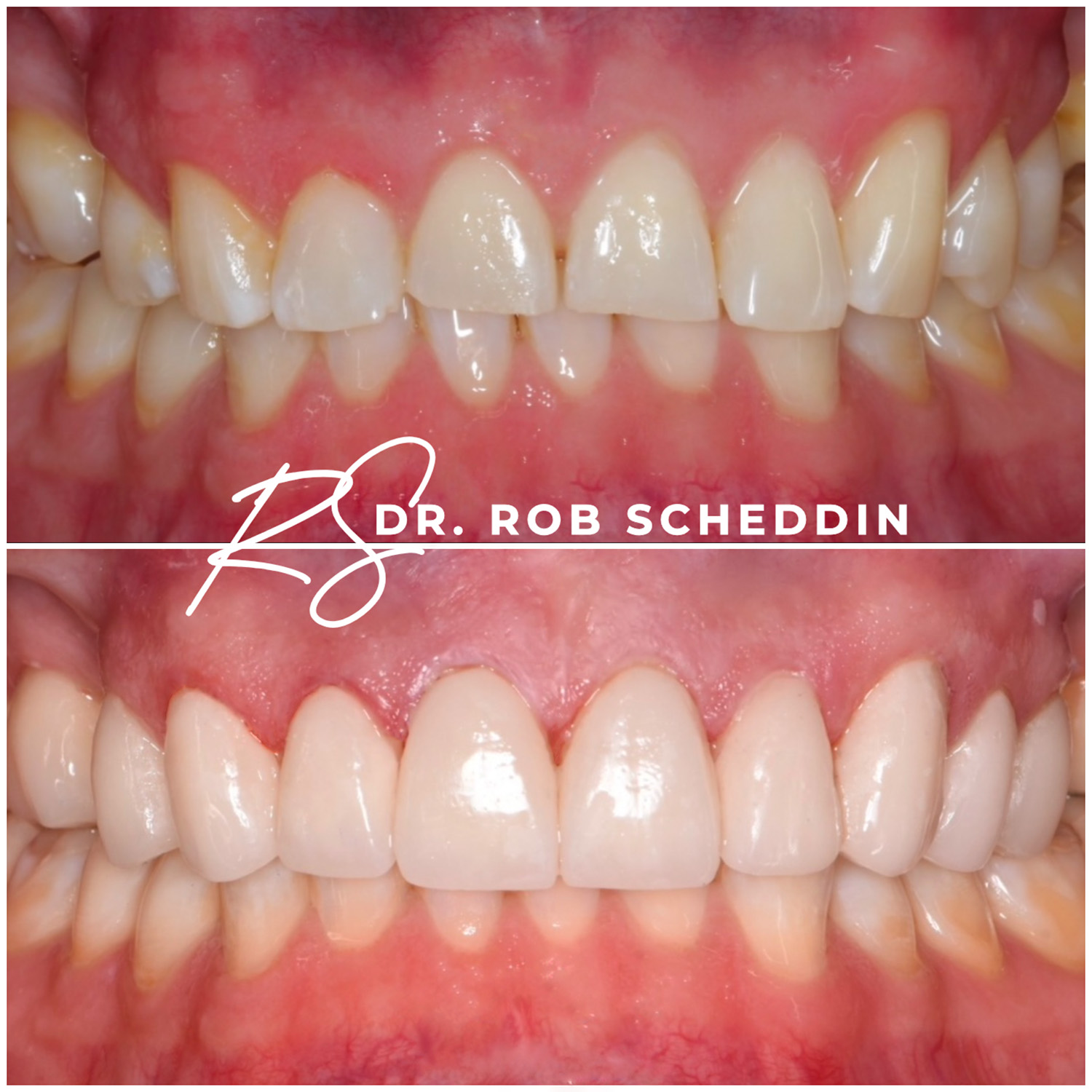 Before and after close-up of upper front teeth showing dental veneers that straighten and whiten the teeth.
