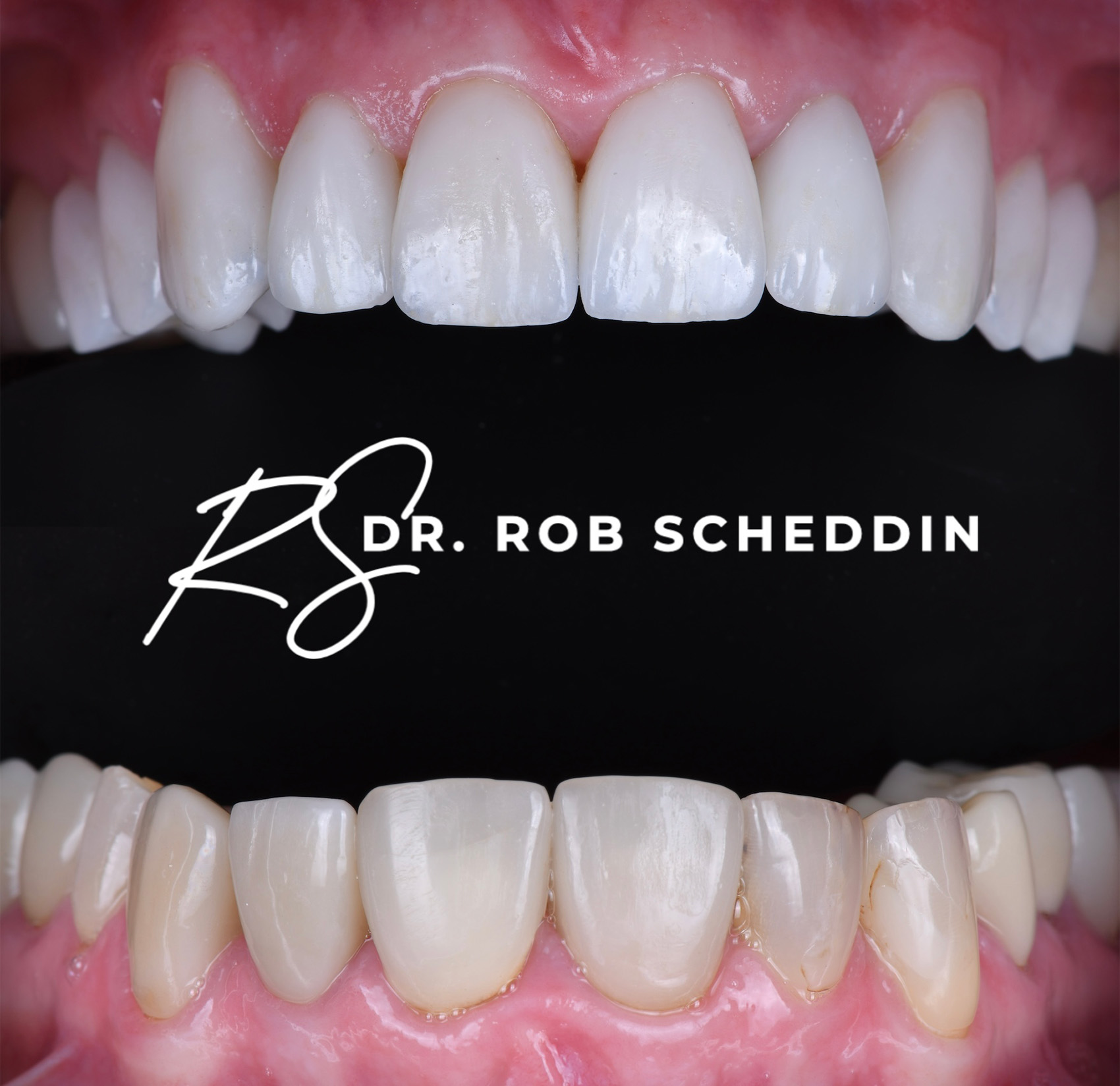 Close-up of upper and lower front teeth with gums visible, featuring the text 'Dr. Rob Scheddin' on a black background between the teeth.