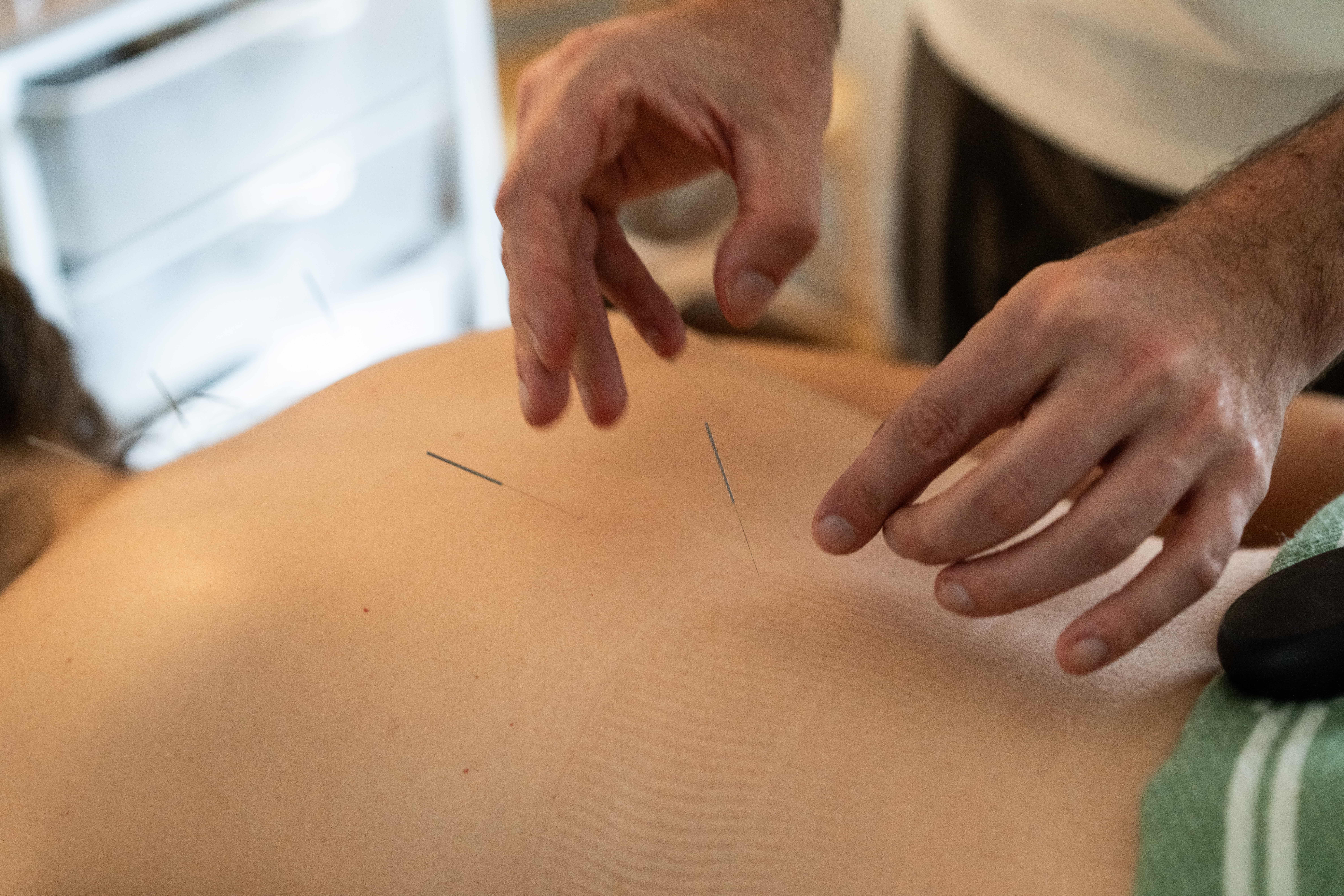 A client experiencing acupuncture in Louisville, KY - supporting stress relief, relaxation, and whole-body healing.