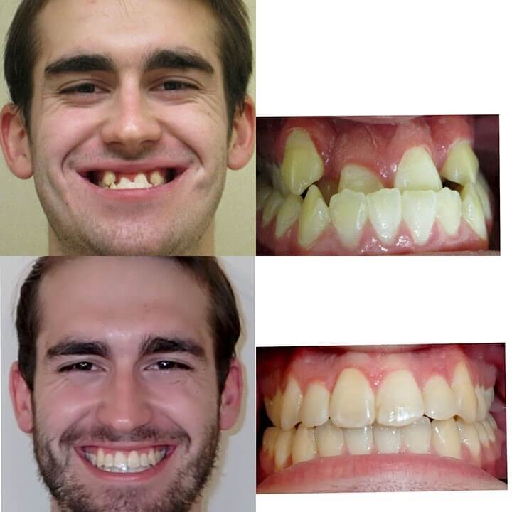 Before and after picture of a dental patient who got their teeth straightened.