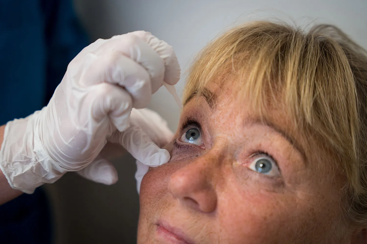 En kvinde med blå øjne får øjendråber indsat af en hånd med hvid handske.