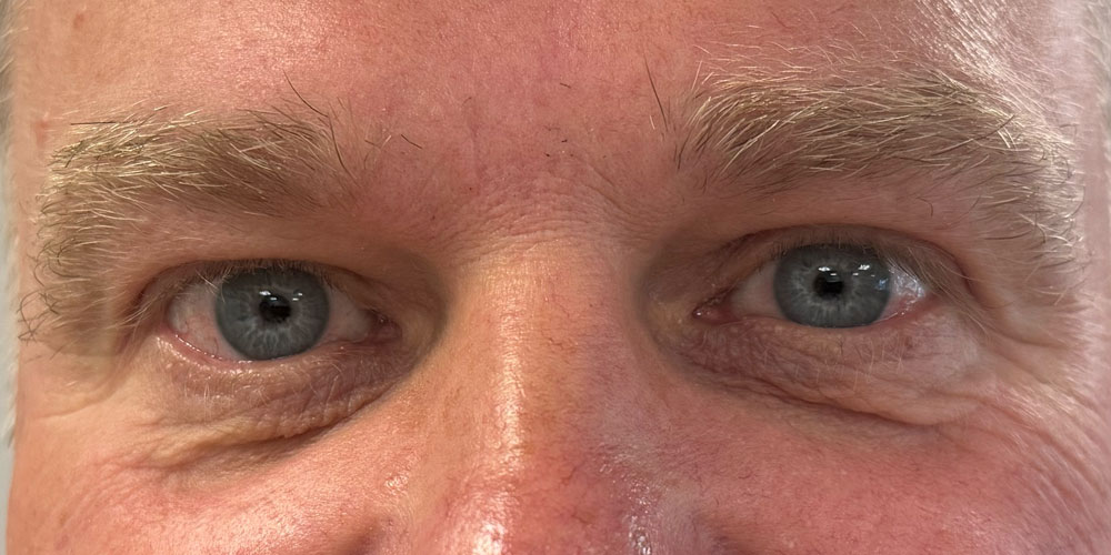 Efter behandling