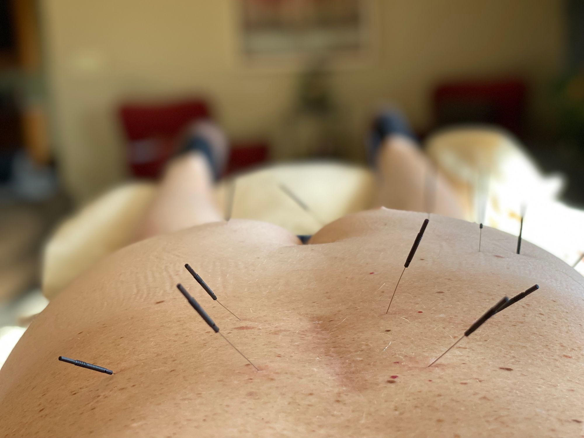 Dry needling