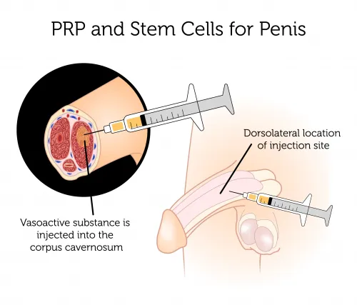 Ved P-Shot-behandlingen injiceres plasmabehandlet blod direkte ind i corpus cavernosum, som er de to cylindriske vævskamre langs den øvre længde af penis.