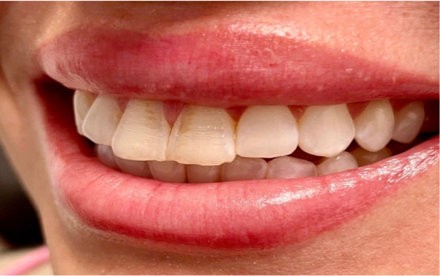 Teeth whitening, before