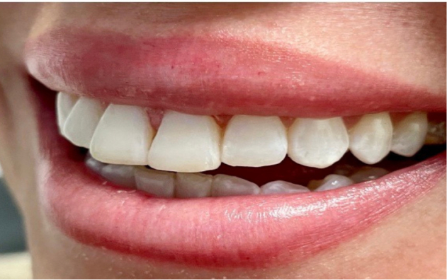 Teeth whitening, after