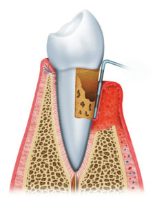 Periodontal disease