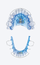 Model of teeth with sleep apnea appliance