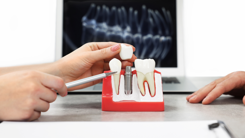 Dental implant model demonstrating the cost and value of dental implants, featuring a titanium implant, abutment, and dental crown used for permanent tooth replacement, restorative dentistry, missing teeth treatment, smile restoration, and long-term oral health.