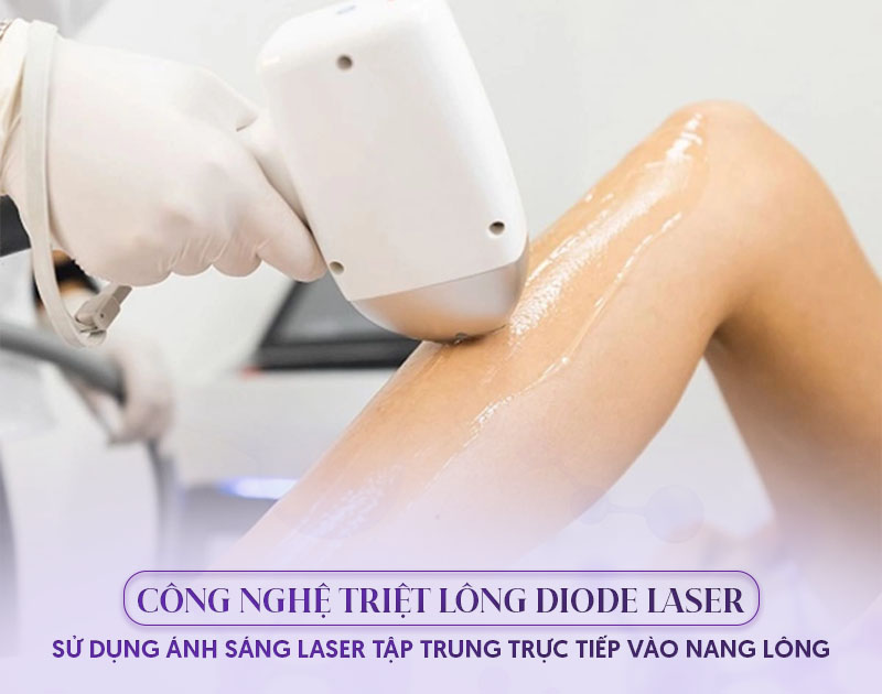 Triệt lông bằng Diode Laser có hại không?