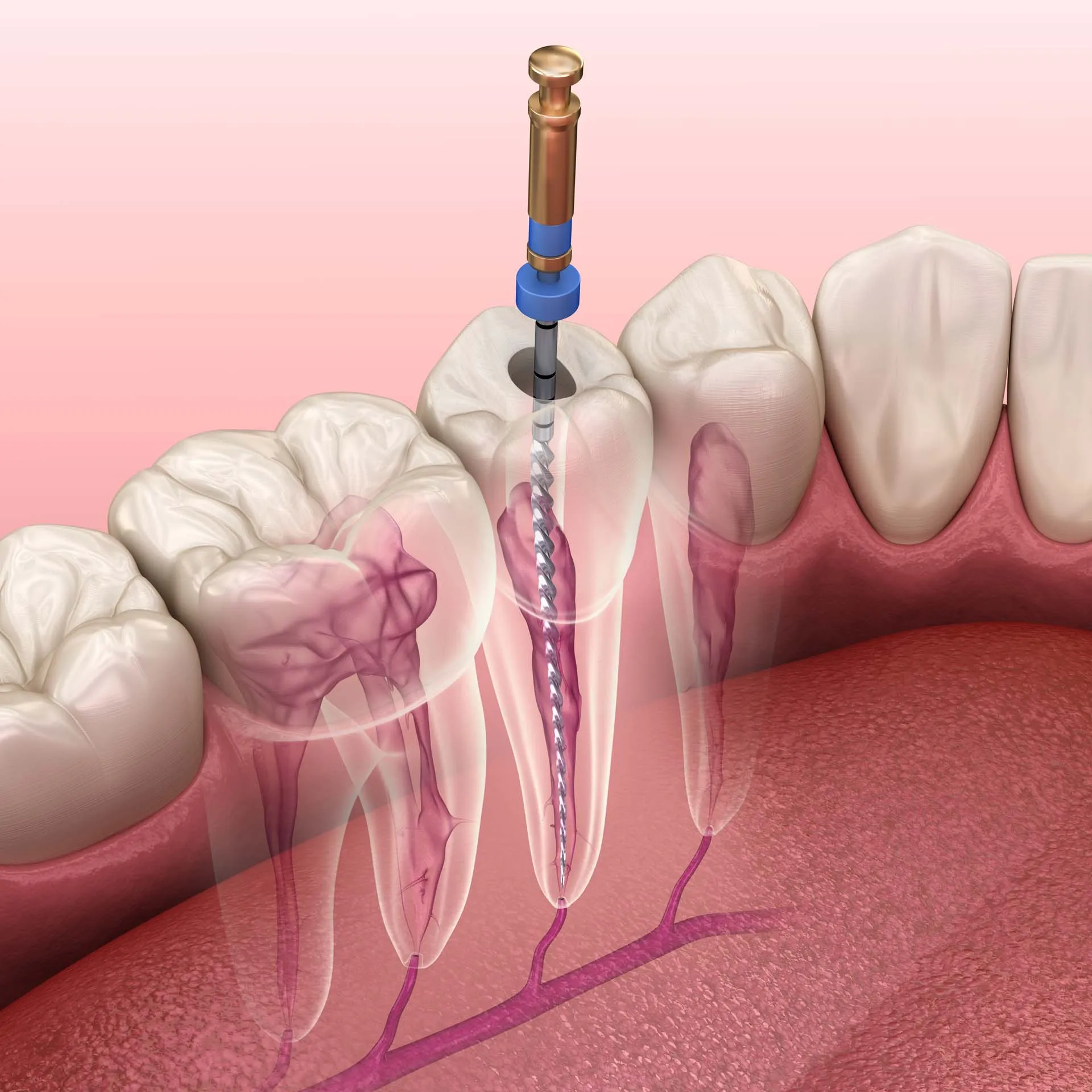 Root Canals